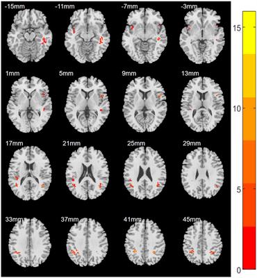 A Comparative Study of Regional Homogeneity of Resting-State fMRI Between the Early-Onset and Late-Onset Recurrent Depression in Adults